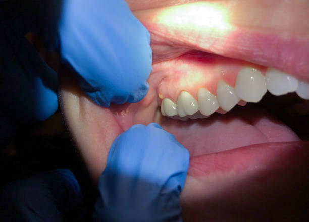 Best Emergency Care for Gum Disease in St Louis Park, MN